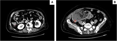 Case report: Stent-first strategy as a potential approach in the management of malignant right-sided colonic obstruction with cardiovascular risks